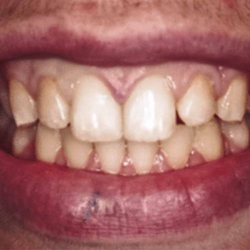 repair damaged tooth